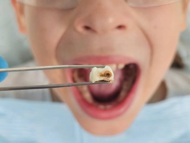Best Broken or Cracked Tooth Emergency Dentist in Searingtown, NY